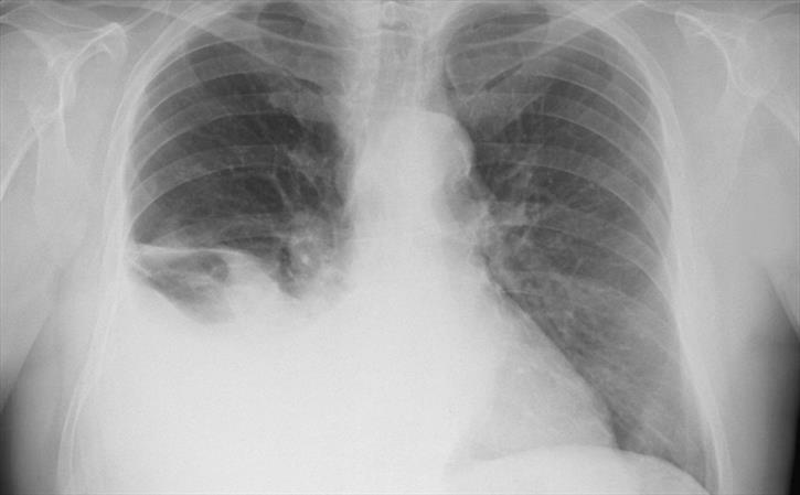 Pleural effusion